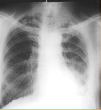 Radiografa de los pulmones.